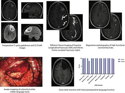 Involvement of White Matter Language Tracts in Glioma: Clinical Implications, Operative Management, and Functional Recovery After Injury